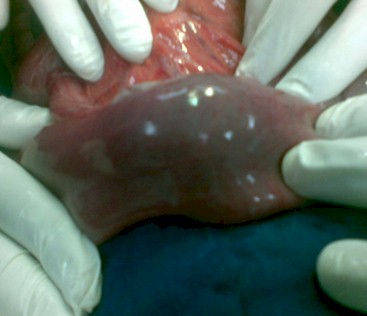 intususcepcion_intestinal_polipo/invaginacion_intestino_delgado intususcepcion_intestinal_polipo/invaginacion_intestino_delgado