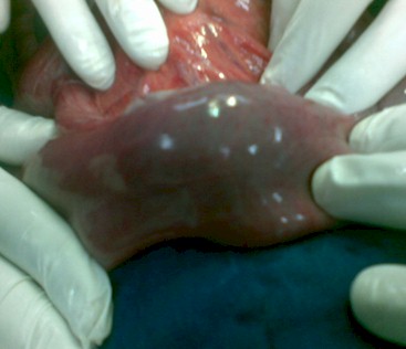 intususcepcion_intestinal_polipo/invaginacion_intestino_delgado