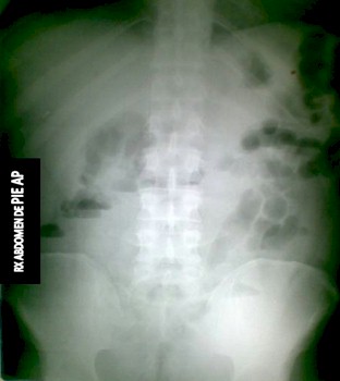 intususcepcion_intestinal_polipo/rx_radiografia_abdomen_AP