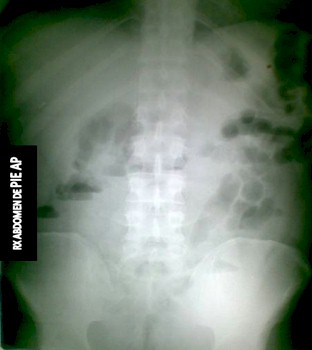 intususcepcion_intestinal_polipo/rx_radiografia_abdomen_AP intususcepcion_intestinal_polipo/rx_radiografia_abdomen_AP