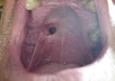 obturador_palatino_oncologia/comunicacion_buco-nasal obturador_palatino_oncologia/comunicacion_buco-nasal