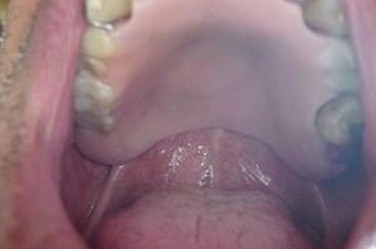 obturador_palatino_oncologia/resultado_cirugia_protesis obturador_palatino_oncologia/resultado_cirugia_protesis