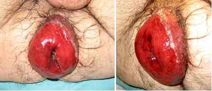 procidencia_aguda_rectal/prolapso_recto_anal procidencia_aguda_rectal/prolapso_recto_anal