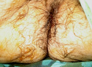 procidencia_aguda_rectal/resultados_cirugia_tratamiento