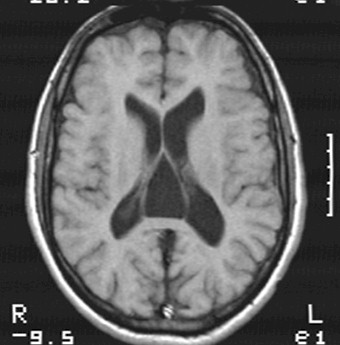 sindrome_Gorlin_caso/clinico_RMN_cerebral