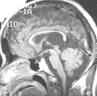 sindrome_Gorlin_caso/clinico_RMN_craneal