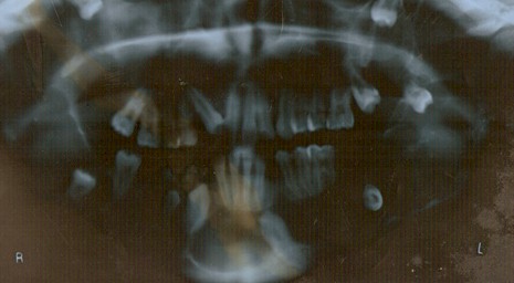 sindrome_Gorlin_caso/ortopantomografia_dentadura_clinico