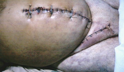 sindrome_compartimental_abdominal/distension_abdominal_laparatomia