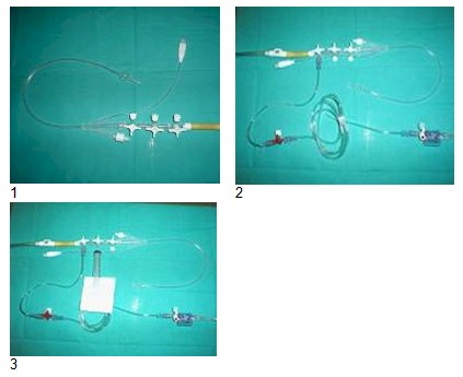 sindrome_compartimental_abdominal/medicion_presion_intraabdominal