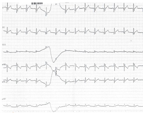 tratamiento_pericarditis_meningococica/bloqueo_rama_derecha