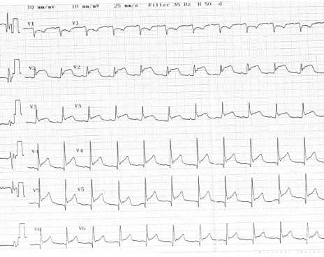 tratamiento_pericarditis_meningococica/elevacion_segmento_ST