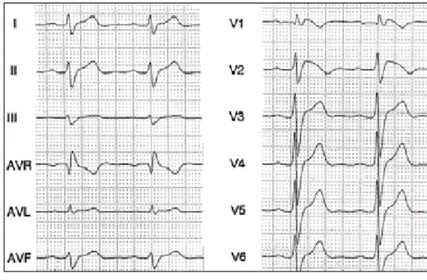 Wolff-Parkinson-White/electrocardiograma_ECG_EKG