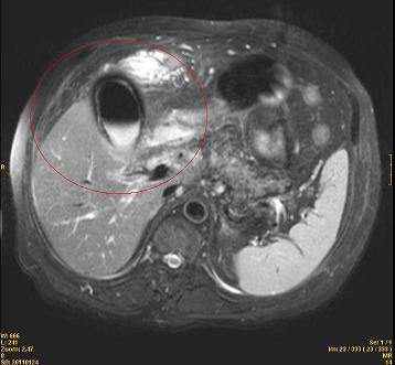colecistitis_enfisematosa_caso/colangioresonancia_magnetica_biliar colecistitis_enfisematosa_caso/colangioresonancia_magnetica_biliar