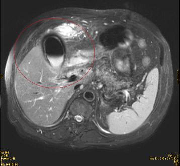 colecistitis_enfisematosa_caso/colangioresonancia_magnetica_biliar