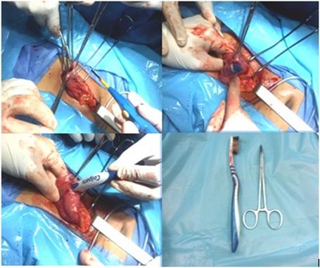 cuerpo_via_digestiva/extraccion_cuerpo_dental cuerpo_via_digestiva/extraccion_cuerpo_dental