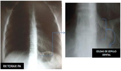 cuerpo_via_digestiva/rx_torax_pc cuerpo_via_digestiva/rx_torax_pc