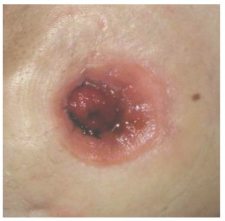 enfermeria_EII_enfermedad_inflamatoria/imagen_dermatitis_irritativa