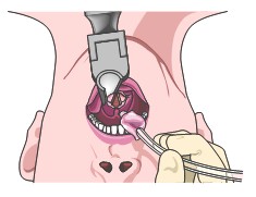 guia_maletines_emergencia/tecnica_de_intubacion2