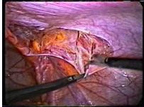 hernia_inguinal_laparoscopia/continuacion_apertura