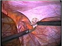 hernia_inguinal_laparoscopia/inicio_diseccion hernia_inguinal_laparoscopia/inicio_diseccion