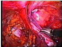 hernia_inguinal_laparoscopia/liberacion_saco hernia_inguinal_laparoscopia/liberacion_saco