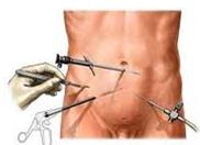 hernia_inguinal_laparoscopia/posicion_trocares hernia_inguinal_laparoscopia/posicion_trocares