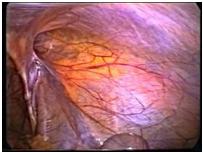 hernia_inguinal_laparoscopia/vision_anatomica_RI hernia_inguinal_laparoscopia/vision_anatomica_RI