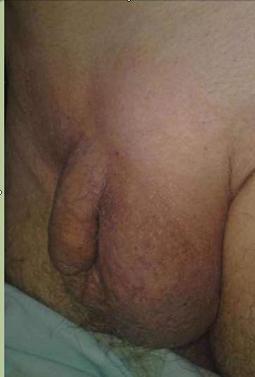 hernia_inguino-escrotal/hernia_despues_toser hernia_inguino-escrotal/hernia_despues_toser