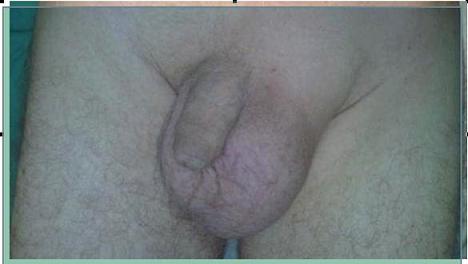 www.portalesmedicos.com/imagenes/publicaciones_11/1109_hernia_inguino-escrotal/hernia_inguino_escrotal.JPG www.portalesmedicos.com/imagenes/publicaciones_11/1109_hernia_inguino-escrotal/hernia_inguino_escrotal.JPG