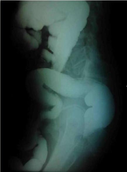 hernia_inguino-escrotal/vista_antero_posterior hernia_inguino-escrotal/vista_antero_posterior