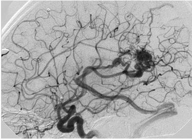 malformaciones_arteriovenosas_cerebrales/angiografia_cerebral