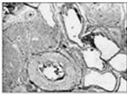 malformaciones_arteriovenosas_cerebrales/macroscopica_mav_cerebral