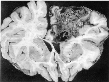 malformaciones_arteriovenosas_cerebrales/mav_cerebral