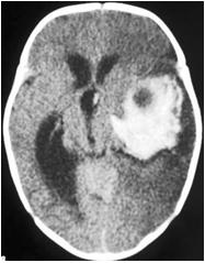 malformaciones_arteriovenosas_cerebrales/tac_cerebral malformaciones_arteriovenosas_cerebrales/tac_cerebral