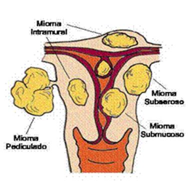 miomatosis_uterina_ginecologia/miomas_uterinos