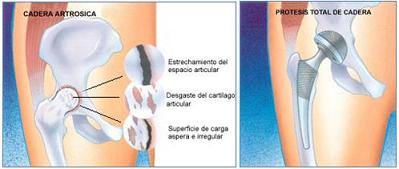 recomendaciones_protesis_cadera/protesis_cadera recomendaciones_protesis_cadera/protesis_cadera