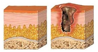 riesgo_ulceras_presion/formacion_ulcera_UPP riesgo_ulceras_presion/formacion_ulcera_UPP