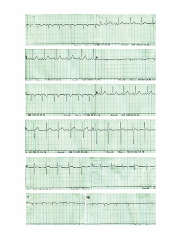 sindrome_Kartagener_caso/clinico_electrocardiograma_ECG