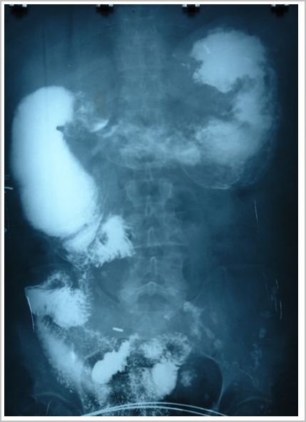 sindrome_Rokitansky_caso/rx_postoperatorio sindrome_Rokitansky_caso/rx_postoperatorio