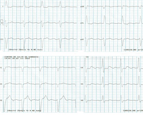 DAI_desfibrilador_implantable/electrocardiograma_ECG_EKG