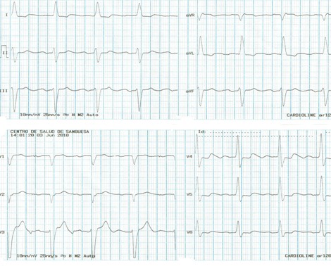 DAI_desfibrilador_implantable/electrocardiograma_ECG_EKG DAI_desfibrilador_implantable/electrocardiograma_ECG_EKG