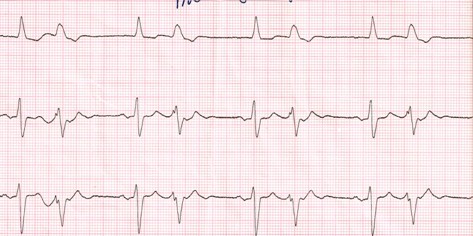 DAI_desfibrilador_implantable/torsades_de_pointes DAI_desfibrilador_implantable/torsades_de_pointes