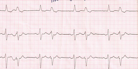 DAI_desfibrilador_implantable/torsades_de_pointes