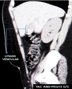 ascaris_via_biliar/litiasis_vesicobiliar_calculos