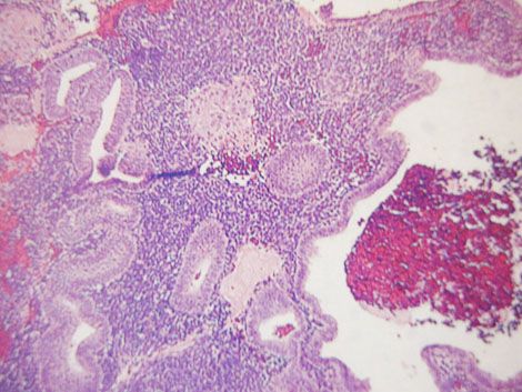 caso_endometriosis_extrapelvica/epitelio_glandular_cilindrico