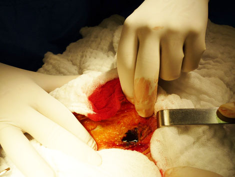 caso_endometriosis_extrapelvica/lesion_aponeurosis_uterina caso_endometriosis_extrapelvica/lesion_aponeurosis_uterina