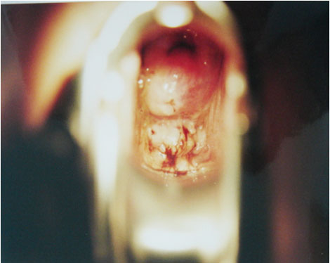 caso_endometriosis_extrapelvica/lesion_fondo_saco caso_endometriosis_extrapelvica/lesion_fondo_saco