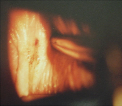 caso_endometriosis_extrapelvica/lesion_mucosa_vaginal caso_endometriosis_extrapelvica/lesion_mucosa_vaginal