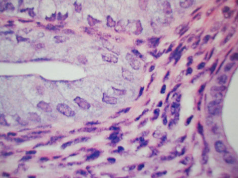caso_endometriosis_extrapelvica/nodulos_hemorragicos_endometriales