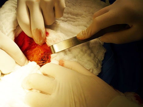 caso_endometriosis_extrapelvica/secrecion_achocolatada_endometrioma caso_endometriosis_extrapelvica/secrecion_achocolatada_endometrioma